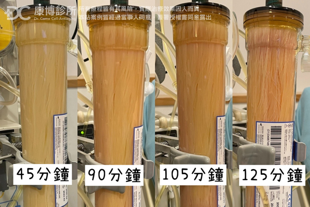 王先生過濾出來的廢液，是鮮少會出現的“橘紅色帶著乳糜塊”，王先生驚訝的表示：「如果沒有做血液淨化，都不知道自己的血液這麼髒！」