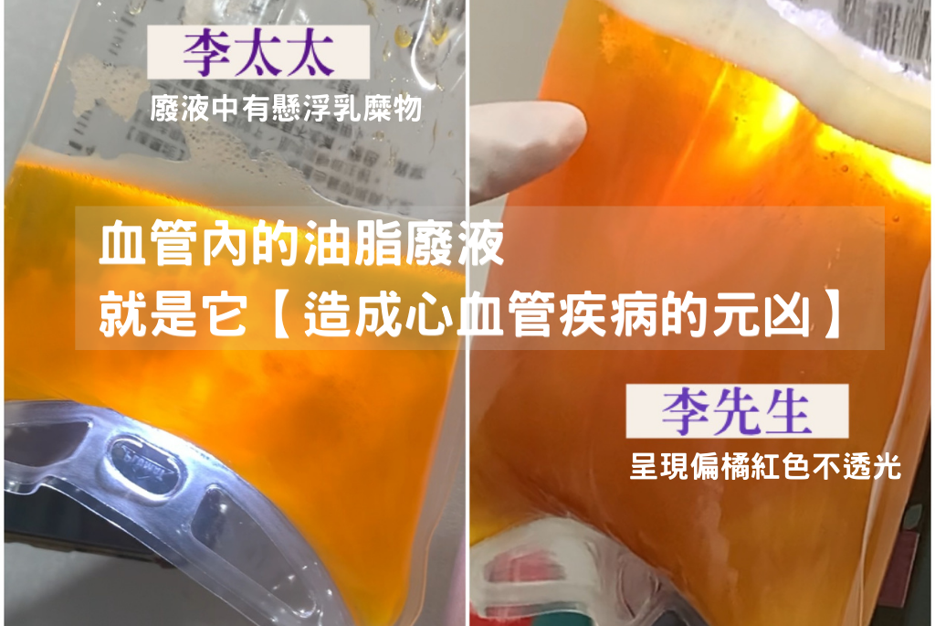 血液淨化過程中，雖然沒有像先生一樣洗出過多血脂而需要濾芯拍打，廢液量也沒有像先生這麼誇張，但最後卻排出許多的發炎物質與懸浮乳糜物，這也大大的讓李太太驚訝！