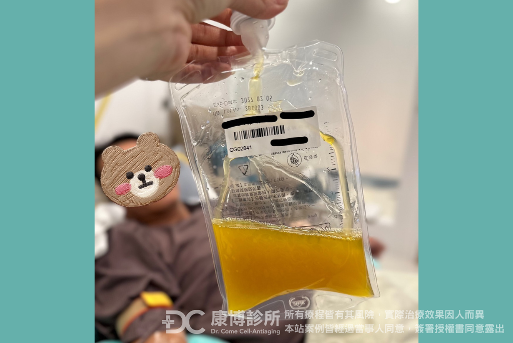 50歲的羅先生血壓偏高，三年前在其他醫美診所做過血液淨化，這次來到康博診所感受到專業服務，從醫師諮詢、護理師衛教，包含施作當天也有泰晶殿的芳療師按摩舒壓。此次的血淨廢液非常濃稠且有沉澱物，為了保持健康，開始調整作息及飲食，讓自己不再處於亞健康狀態。